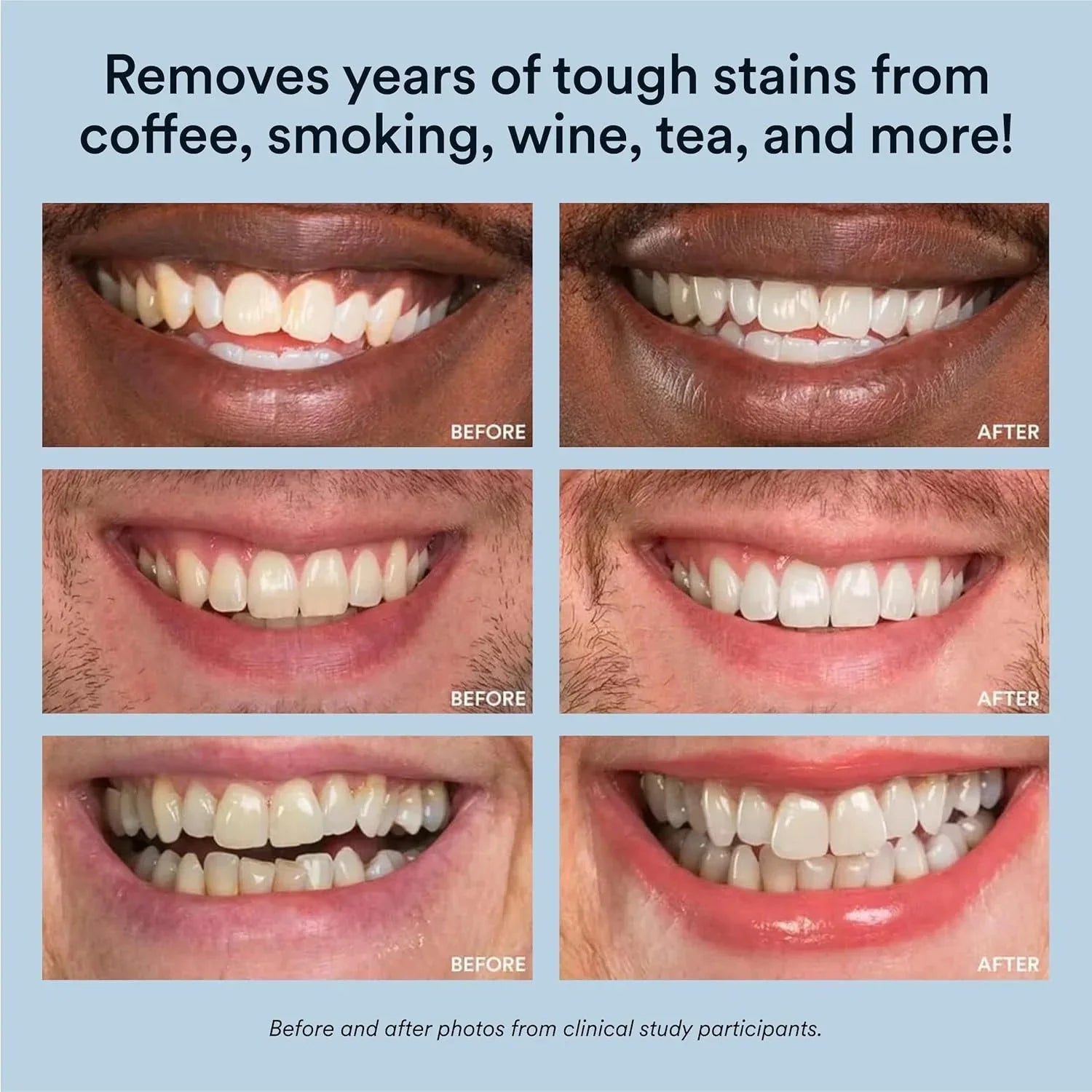 Teeth Whitening Kit with LED Light, 35% Carbamide Peroxide Gel, 20+ Whitening Treatments, (2) 5Ml Whitening Gel Syringes