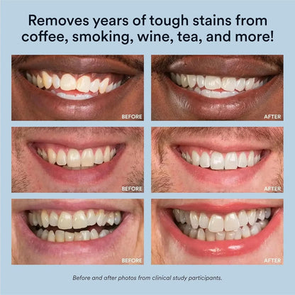 Teeth Whitening Kit with LED Light, 35% Carbamide Peroxide Gel, 20+ Whitening Treatments, (2) 5Ml Whitening Gel Syringes